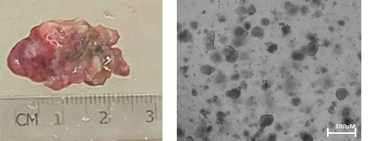 Tumor tissue and tumor organoids generated from the tumor tissue Tumor tissue and tumor organoids generated from the tumor tissue